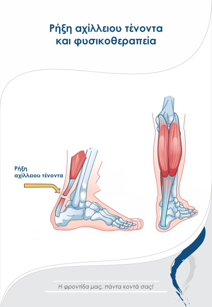 Άρθρο για τη ρήξη αχίλλειου τένοντα