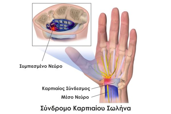 syndromo-karpiaiou-swlina4